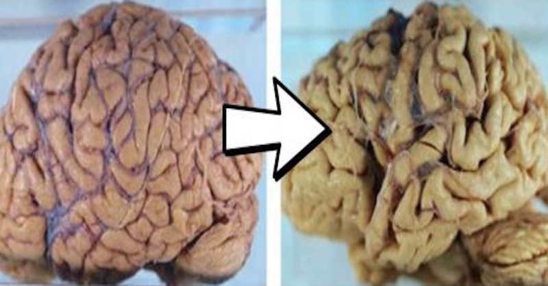 Ako s pomocou arašidového masla včas odhaliť Alzheimerovú chorobu