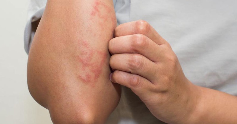 7 domácich liekov na mykózu kože, ak nemáte čas chodiť po lekároch
