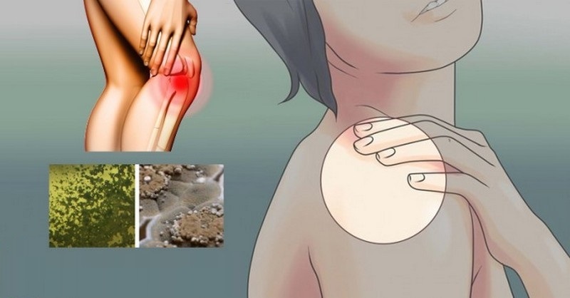 14 príznakov, že máte v tele plesňovú infekciu a na ktoré potraviny si dávať pozor