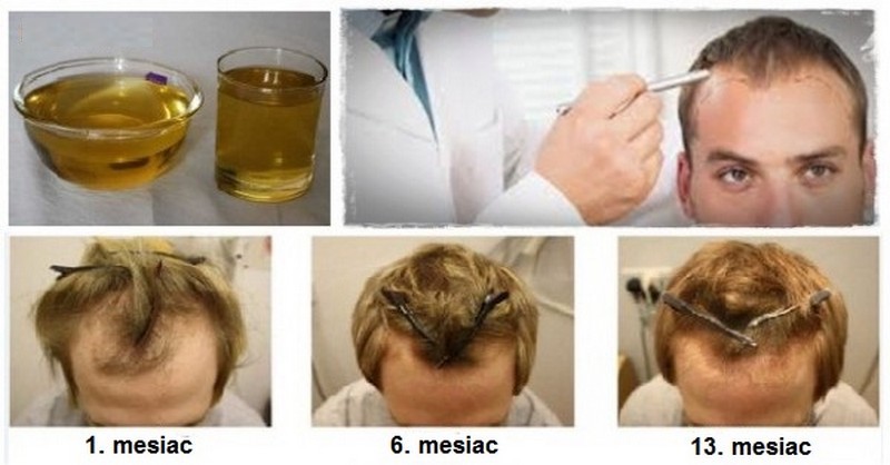 Zázračný olej, čo zastaví vypadávanie a dokonca obnoví rast vašich vlasov