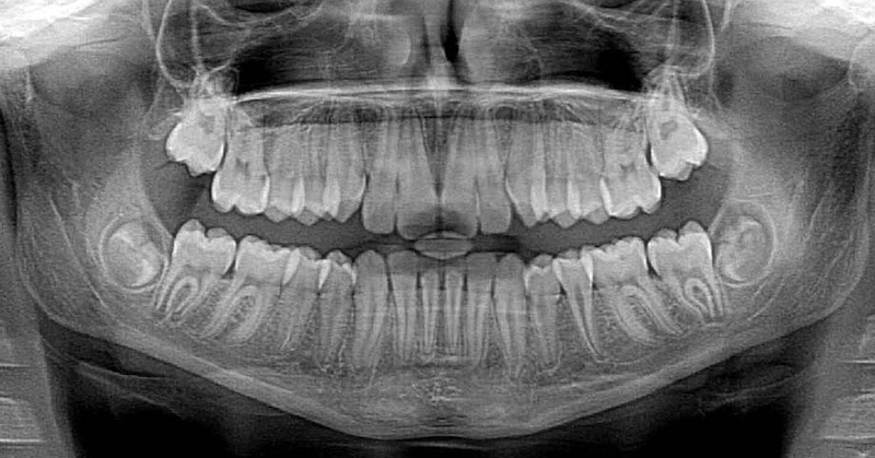 Podľa odborníkov sa zuby múdrosti v až 67% prípadov trhajú zbytočne