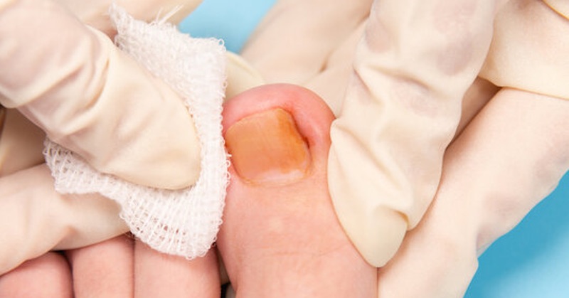 5 domácich spôsobov, ako sa zbaviť nepríjemnej mykózy kože a nechtov na nohách