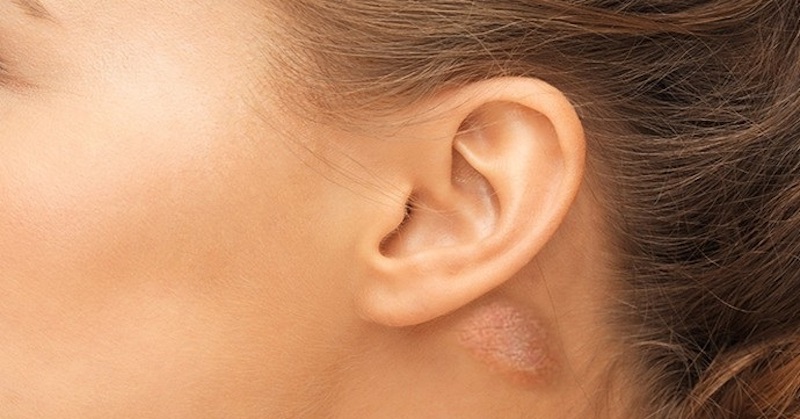 Čo spôsobuje hrčku za uchom, ako ju liečiť doma a kedy ísť k lekárovi