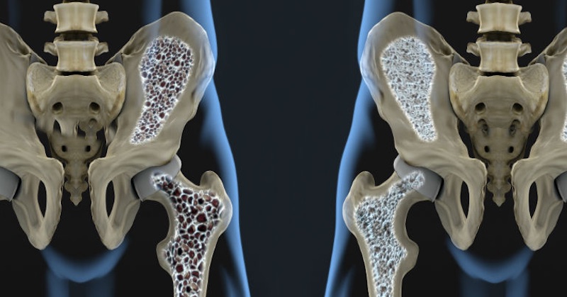 Lekári sa mýlia: Osteoporóza je "skorbut" kostí, nie nedostatok vápnika