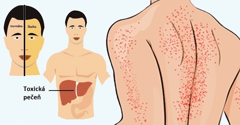 12 varovných príznakov, ktorými vám telo naznačuje, že máte chorú pečeň