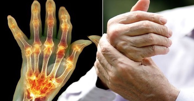 5 bežných potravín, ktoré vám pomôžu znížiť bolesti kĺbov spôsobené artritídou