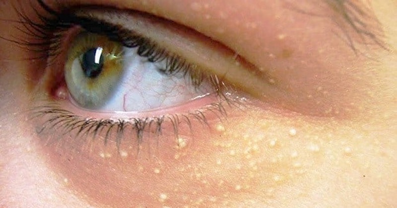 5 prírodných spôsobov, ako odstrániť žlté podkožné hrudky okolo očí a nosa