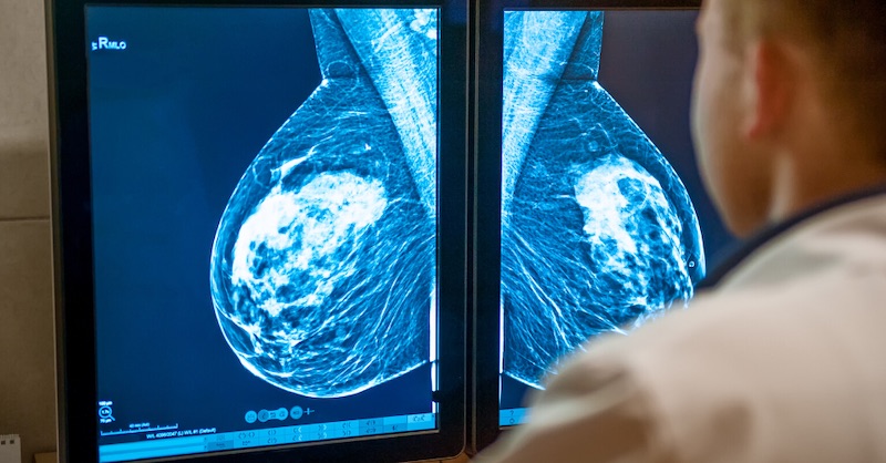 O čom musíte vedieť: 2 hlavné príčiny spôsobujúce rakovinu prsníka