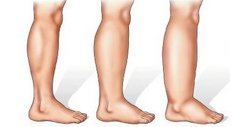 Príčiny a prírodná liečba opuchnutých nôh v oblasti lýtok, členkov a chodidiel