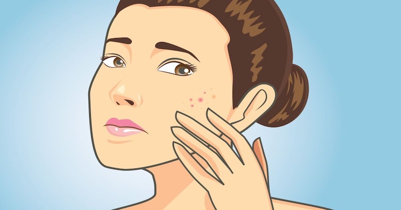 Ako pomocou polohy akné na tvári zistiť, ktorý orgán v tele je chorý