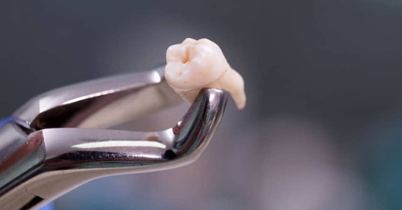 Ako sa rozhodnúť, keď vám zubár odporúča preventívne vytrhnúť zuby múdrosti