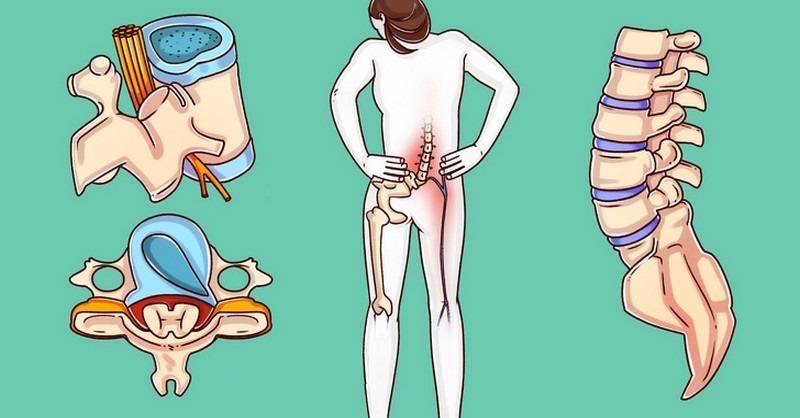 Špičkový chirurg odporúča 6 cvikov, ktoré vám napravia chrbticu a odstránia bolesti chrbta