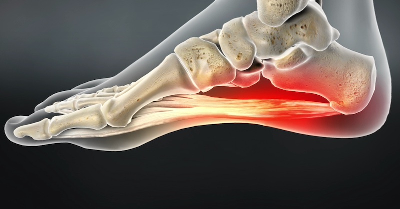 Zásady prevencie a domáce spôsoby liečby plantárnej fasciitídy (bežeckej päty)